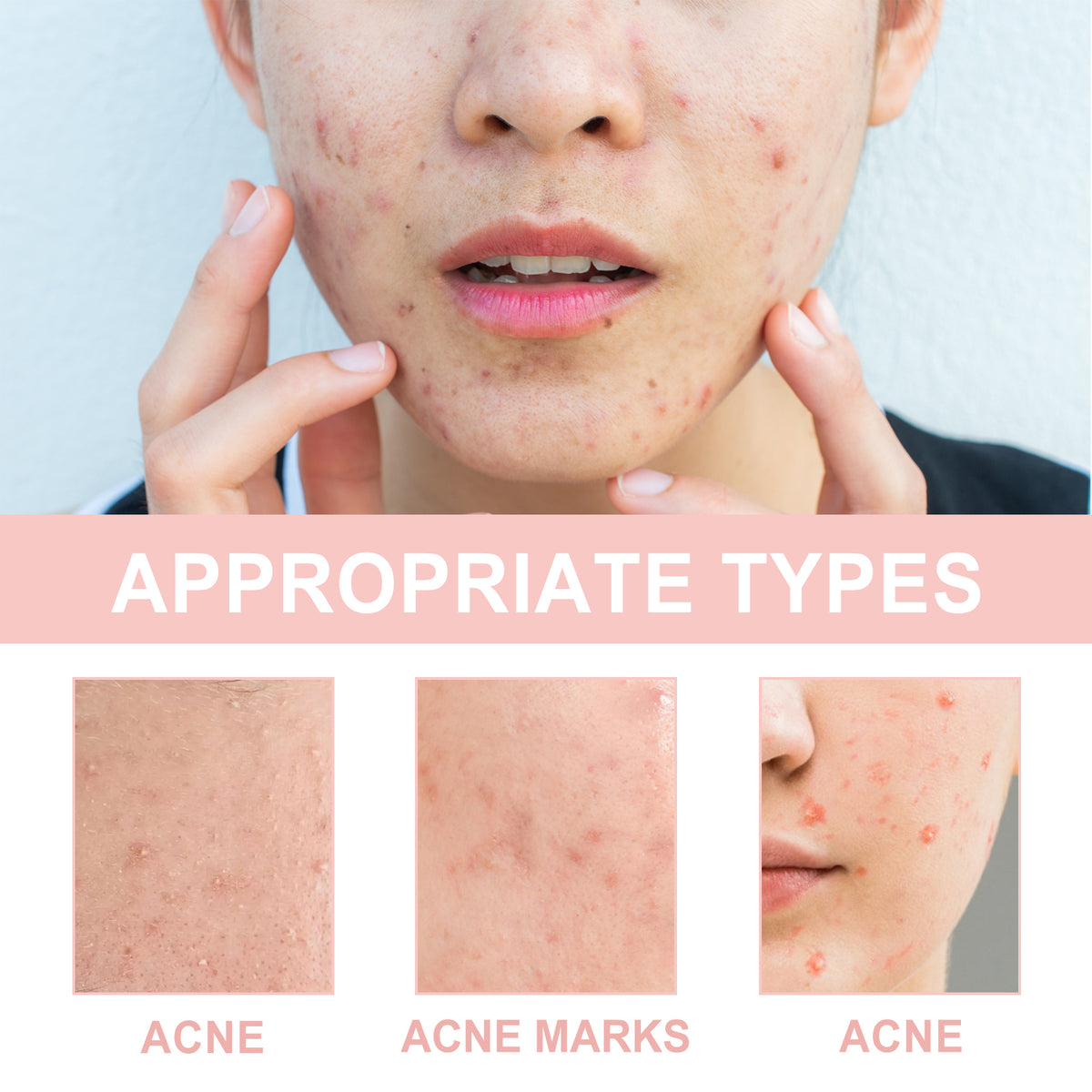 Acne Patch, Repair Acne Pimple Facial Redness Clean Pores Moisturize Skin Patch - American Smart
