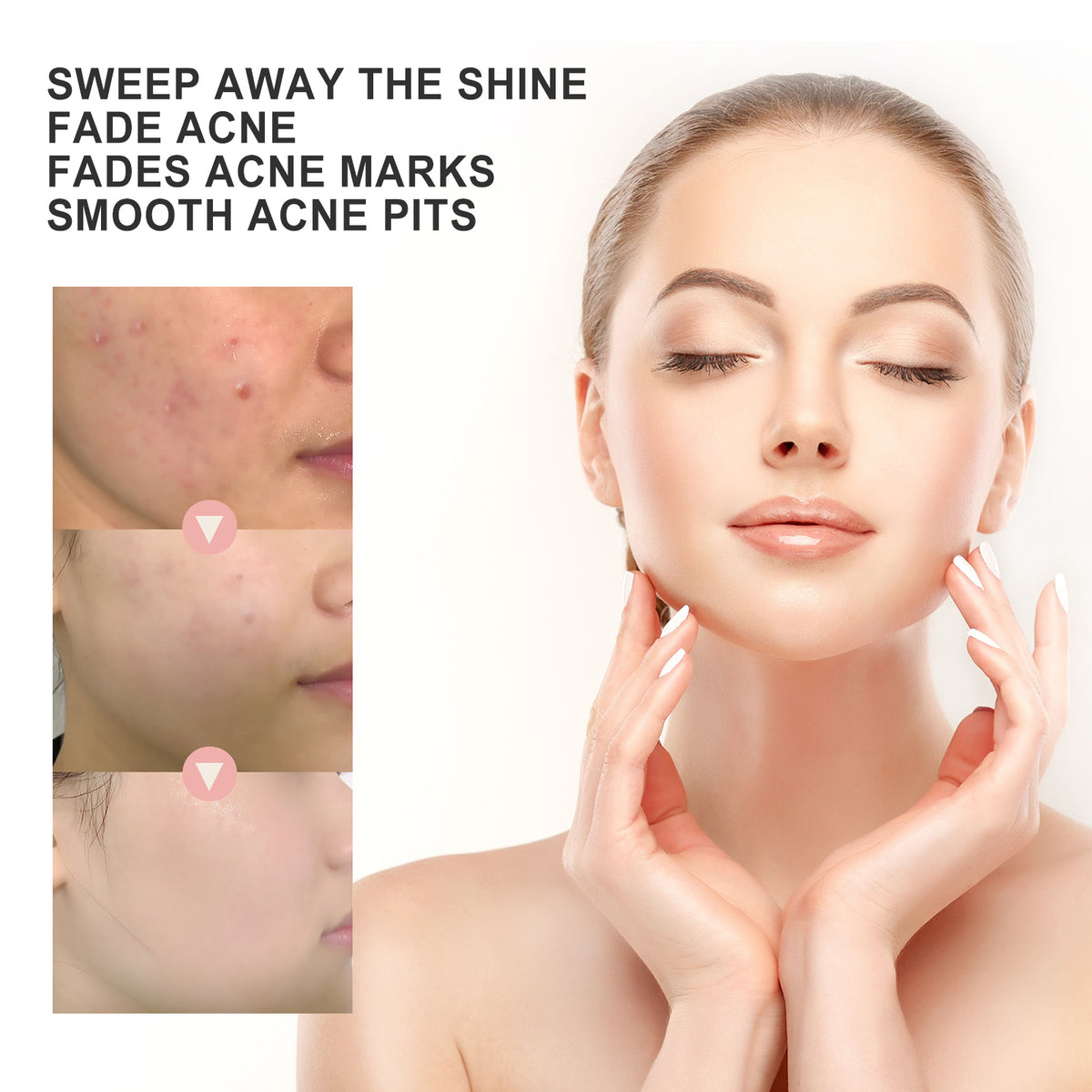 Acne Patch, Repair Acne Pimple Facial Redness Clean Pores Moisturize Skin Patch - American Smart