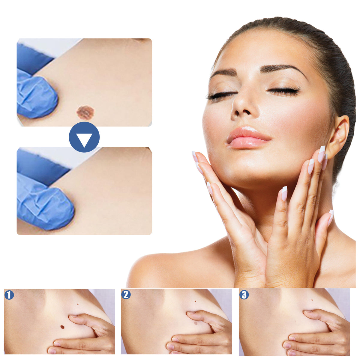 EELHOE Gram Wart Corns Patch by eprolo, skin care patch for warts, moles, and flesh blemishes on skin.