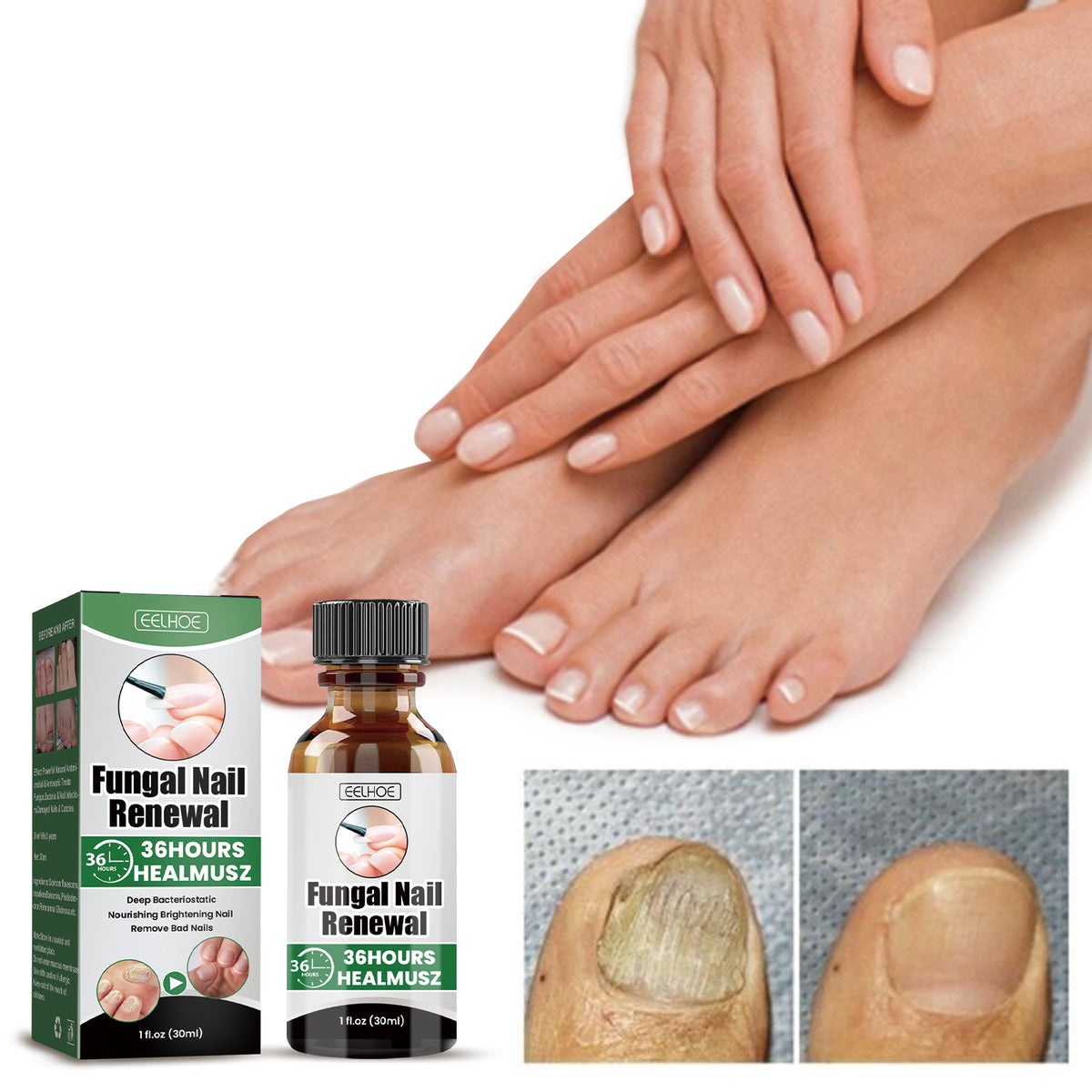 EELHOE Gray Nail Repair Remove Gray Nail Nourishing Lotion, Brightening Soft Nails Moisturizing Nail Care Solution For Hands, Feet And Nails - American Smart