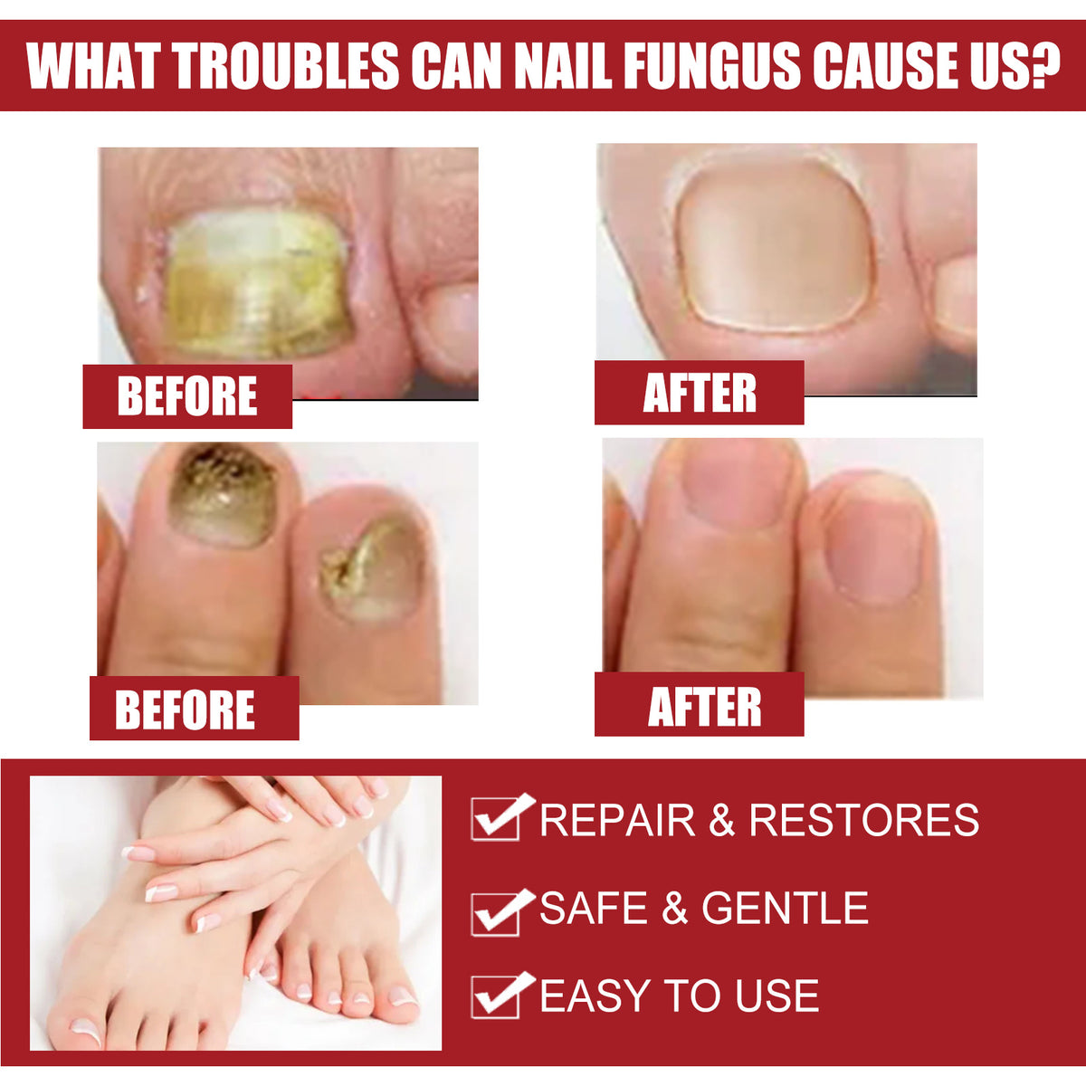 EELHOE Nail Repair Solution, Hands And Feet Nail Repair Moisturizing Clean And Remove Gray Nail Repair Solution - American Smart