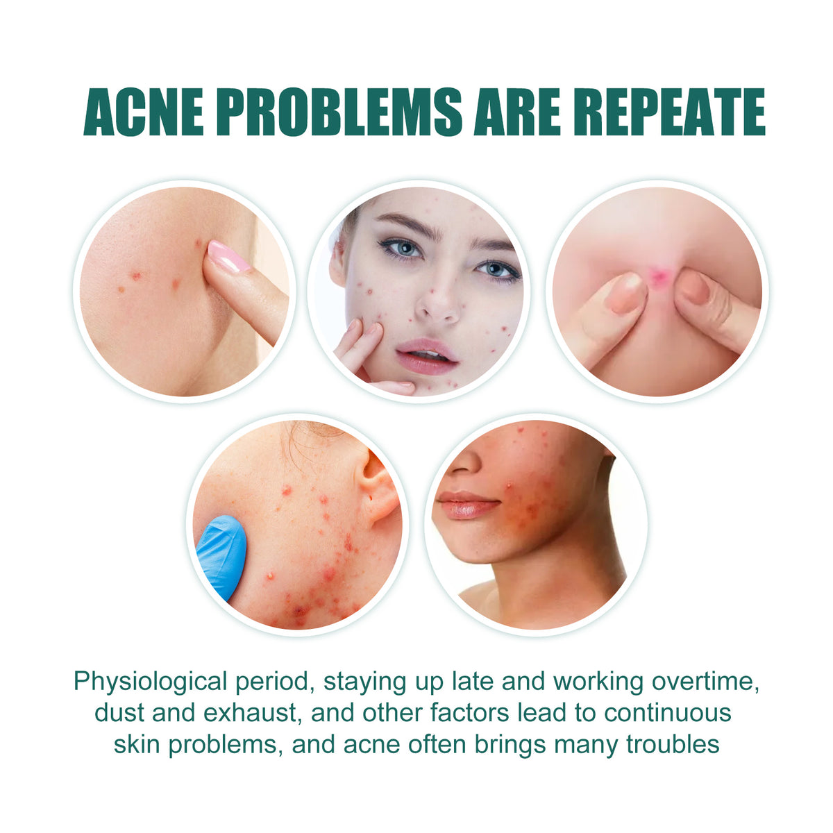 EELHOE Star Acne Patch Gentle Cleansing Lighten Acne Soothing Skin Acne Patch Facial Cleansing Treatment - American Smart