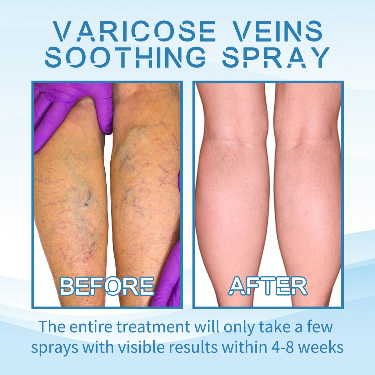 eprolo vein treatment spray for leg soreness and swelling, featuring a pump bottle with clear liquid for vein repair and relief